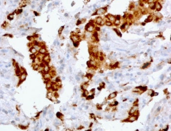 IHC staining of FFPE human lung adenocarcinoma with recombinant Napsin A antibody (clone NPSNA-2R). 