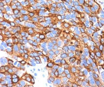 IHC testing in human melanoma stained with MART-1 antibody cocktail.