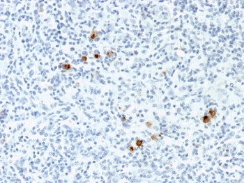 IHC staining of FFPE Hodgkin's Lymphoma with EBV antibody (clone CS4). HIER: boil tissue sections in