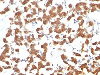 IHC analysis of formalin-fixed, paraffin-embedded human thyroid carcinoma stained with Keratin 18 an