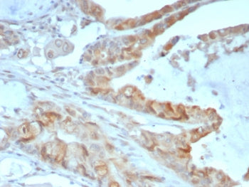 IHC staining of FFPE human colon cancer tissue with ANXA2 antibody (clone 3D5/4). HIER: boil tissue 