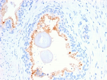 IHC staining of FFPE human prostate carcinoma with CD10 antibody (clone MME/2580). HIER: boil tissue