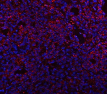 Immunofluorescent staining of FFPE human thyroid cancer with Prosaposin antibody (red) and DAPI nucl