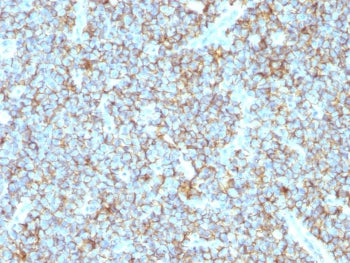 IHC testing of FFPE human Ewing's sarcoma with recombinant CD99 antibody (clone MIC2/1495R). Require