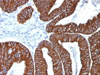 IHC analysis of FFPE human colon carcinoma with Cytokeratin 8/18 antibody (clone 5D3). Required HIER
