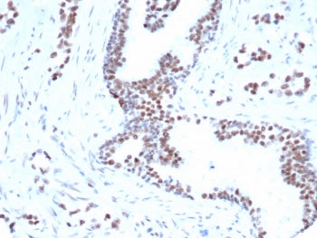 IHC staining of FFPE human prostate carcinoma tissue with FOXP1 antibody (clone rFOXP1/6902) [1ug/ml