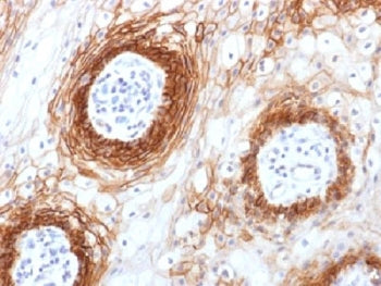 IHC testing of FFPE human tongue carcinoma with CD44v6 antibody (clone CD44v6/1246). Required HIER: 