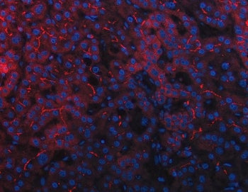 Immunofluorescent staining of FFPE human liver cancer tissue with DEP1 antibody (red) and DAPI nucle