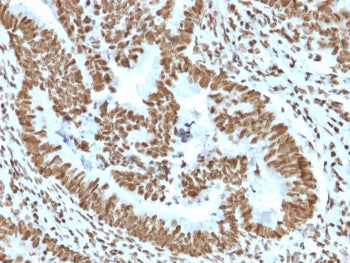 IHC staining of FFPE human colon carcinoma tissue with ZNF690 / ZSCAN29 antibody (clone PCRP-ZNF846-