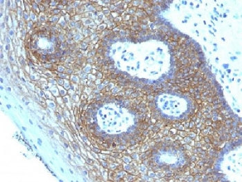 IHC testing of FFPE human cervical squamos cell carcinoma with CD44v4 antibody (clone CD44v4/1219). 