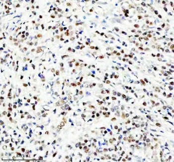 IHC staining of FFPE human breast cancer tissue with NEDD9 antibody. HIER: boil tissue sections in p