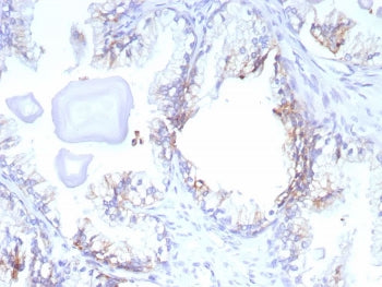 IHC staining of FFPE human prostate cancer tissue with MRP4 antibody (clone ABCC4/9179). HIER: boil 