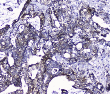 IHC staining of FFPE human intestinal cancer with Cdk6 antibody at 1ug/ml. HIER: boil tissue section