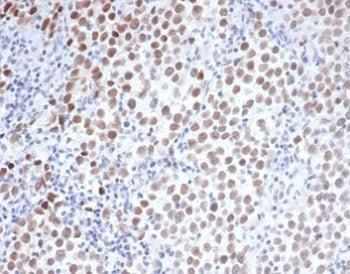 IHC staining of FFPE human seminoma with Oct4 antibody (clone Oct4/3508). HIER: boil tissue sections