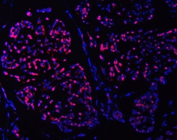 Immunofluorescent staining of FFPE human breast cancer tissue with SMC6 antibody (red) and DAPI nucl