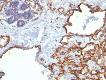 IHC staining of FFPE human angiosarcoma with CD31 antibody (clone SPM122). HIER: boil tissue section