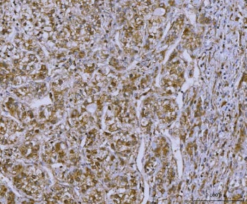 IHC staining of FFPE human liver cancer tissue with SLC22A7 antibody. HIER: boil tissue sections in 