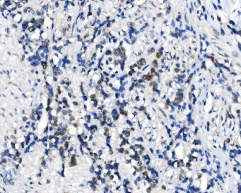 IHC staining of FFPE human gastric cancer with METTL3 antibody. HIER: boil tissue sections in pH8 ED