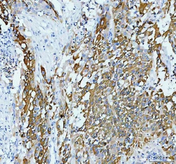 IHC staining of FFPE human bladder infiltrating urothelial carcinoma with squamous differentiation t