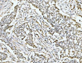 IHC staining of FFPE human lung cancer tissue with RPS6KA4 antibody. HIER: boil tissue sections in p
