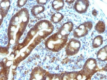 IHC testing of FFPE human duodenal carcinoma with TDP2 antibody (clone TDP2/1258). Required HIER: bo