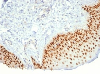 IHC staining of FFPE human prostate cancer with recombinant p40 antibody (clone P40/7302R). HIER: bo