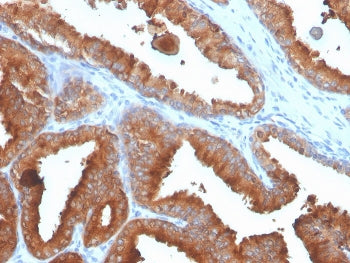 IHC staining of FFPE human prostate carcinoma with recombinant Prostate Specific Antigen antibody (c