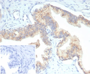 IHC staining of FFPE human prostate carcinoma tissue with PTEN antibody (clone PTEN/7345) at 2ug/ml.