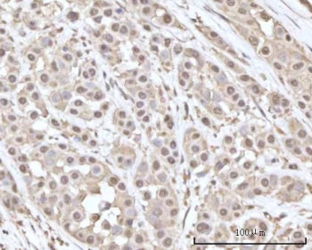 IHC staining of FFPE human breast cancer tissue with Recoverin antibody. HIER: boil tissue sections 
