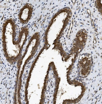 IHC staining of FFPE human breast cancer with BCRP antibody. HIER: boil tissue sections in pH8 EDTA 