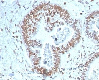 IHC staining of FFPE human prostate carcinoma tissue with ZNF704 antibody (clone PCRP-ZNF704-3C10). 