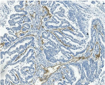 IHC staining of FFPE human rectal cancer with MCAM antibody. HIER: boil tissue sections in pH8 EDTA 