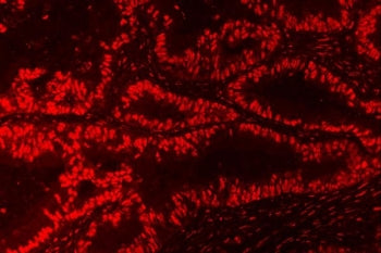 Immunofluorescent staining of FFPE human intestinal cancer tissue with Nucleophosmin antibody. HIER: