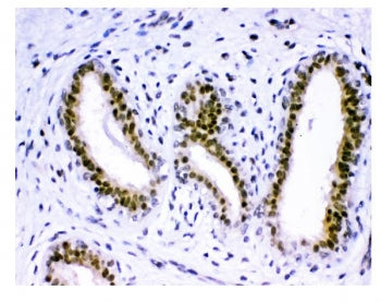 IHC staining of FFPE human breast cancer tissue with KDM5B antibody. HIER: boil tissue sections in p