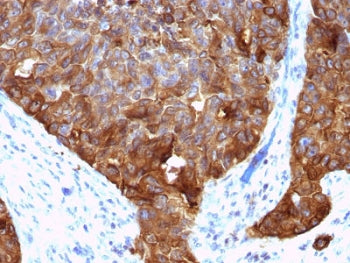 IHC testing of FFPE human colon carcinoma with MUC1 antibody (clone VU-4H5). HIER: requires steaming