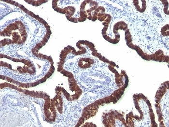 IHC: Formalin-fixed, paraffin-embedded ovarian carcinoma stained with Cytokeratin 7 antibody (clone 