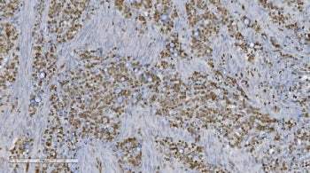 IHC staining of FFPE human gastric cancer tissue with Aryl hydrocarbon Receptor antibody. HIER: boil tissue sections in pH8 EDTA for 20 min and allow to cool before testing.