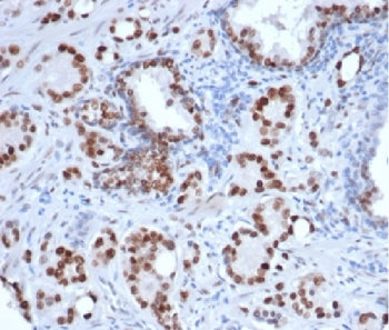 IHC staining of FFPE human prostate carcinoma tissue with recombinant AR antibody (clone rDHTR/6818)