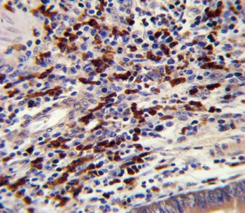 IHC testing of FFPE human colon carcinoma tissue with CNOT8 antibody. HIER: steam section in pH6 cit