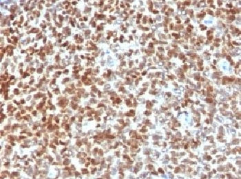 IHC testing of FFPE Ewings sarcoma with NKX2.2 antibody. HIER: steam sections in 10mM citrate buffer