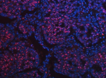 Immunofluorescent staining of FFPE human lung squamous cell carcinoma tissue with SCML1 antibody (re