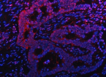 Immunofluorescent staining of FFPE human intestinal cancer tissue with Proteasome subunit beta type 
