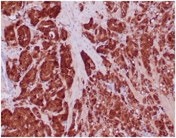 IHC staining of IDH1-R132H mutation protein in FFPE human prostate carcinoma tissue with IDH1-R132H 