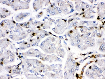IHC testing of FFPE human pancreatic cancer tissue with Fos B antibody. HIER: Boil the paraffin sect