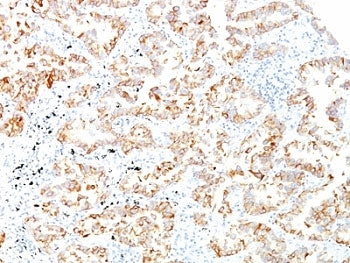 IHC: Formalin-fixed, paraffin-embedded human lung SCC stained with Keratin 7 antibody (clone SPM270)
