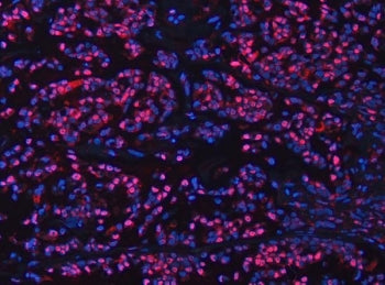 Immunofluorescent staining of FFPE human breast cancer tissue with UBC12 antibody (red) and DAPI nuc