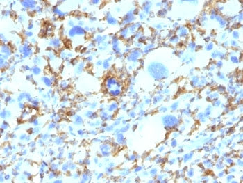 Formalin-fixed, paraffin-embedded human Histiocytoma stained with anti-HLA-DRB1 antibody (clone SPM4