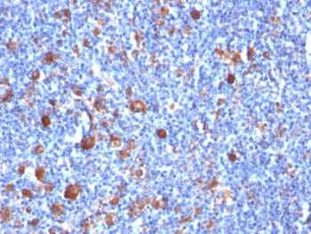 IHC analysis of formalin-fixed, paraffin-embedded human Hodgkin's lymphoma stained with Fascin antib