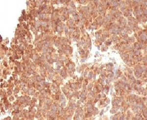IHC: Formalin-fixed, paraffin-embedded human melanoma stained with TOP1MT antibody (clone TOP1MT/488