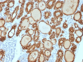 IHC staining of FFPE human thyroid carcinoma with recombinant Thyroid Peroxidase antibody (clone TPO